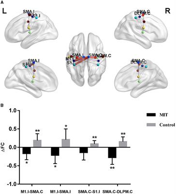 Motor imagery therapy improved upper limb motor function in stroke patients with hemiplegia by increasing functional connectivity of sensorimotor and cognitive networks